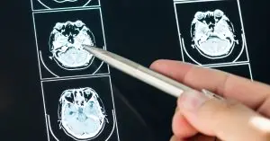 Speech-Impaired Stroke Patients Face Rehab Inequality