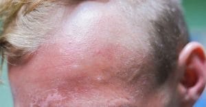 precancerous skin